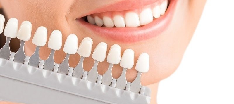 Clareamento Dental ou Facetas de Porcelana: Qual é o melhor?