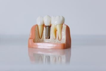 IMPLANTES DENTÁRIOS